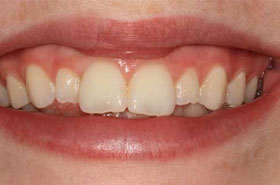 Smile1-before