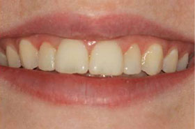 smile1-after
