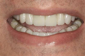 smile2-after