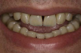 smile2-before