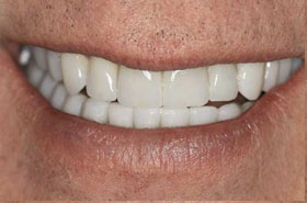 smile3-after