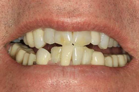 smile3-before