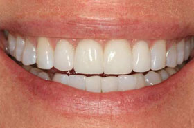 smile4-after