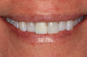 smile4-before