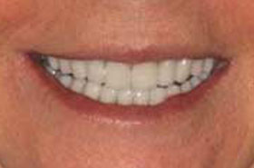 smile5-after