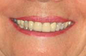 smile5-before